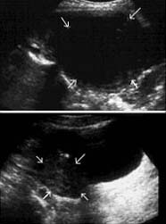 grapefruit size (10 cm) fibroid